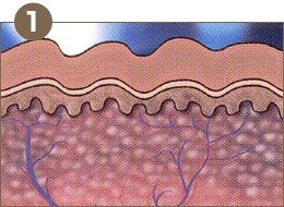 リフトアップレーザー