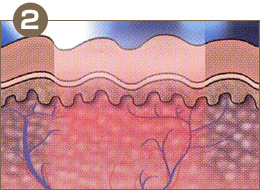リフトアップレーザー