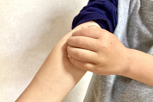 アトピー性皮膚炎