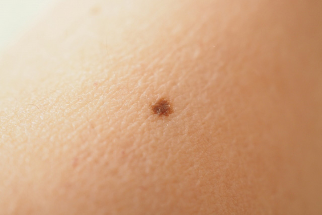 ほくろ
